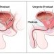 Prostaat-prestatie lage rug pijn