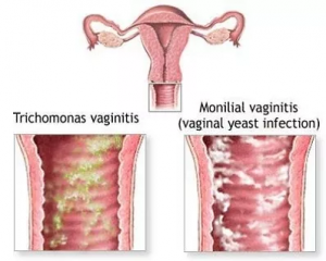 fluor albus door een vaginitis