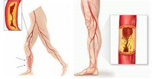 Claudicatio Intermittens (etalagebenen) - Osteopathie, Mesologie ...