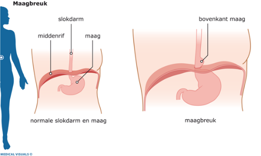 Hernia Hiatalis Middenrifbreuk Osteopathie Mesologie