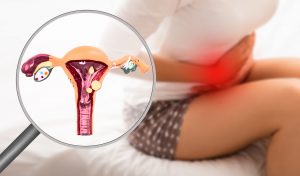 endometriose en verschillende oorzaken