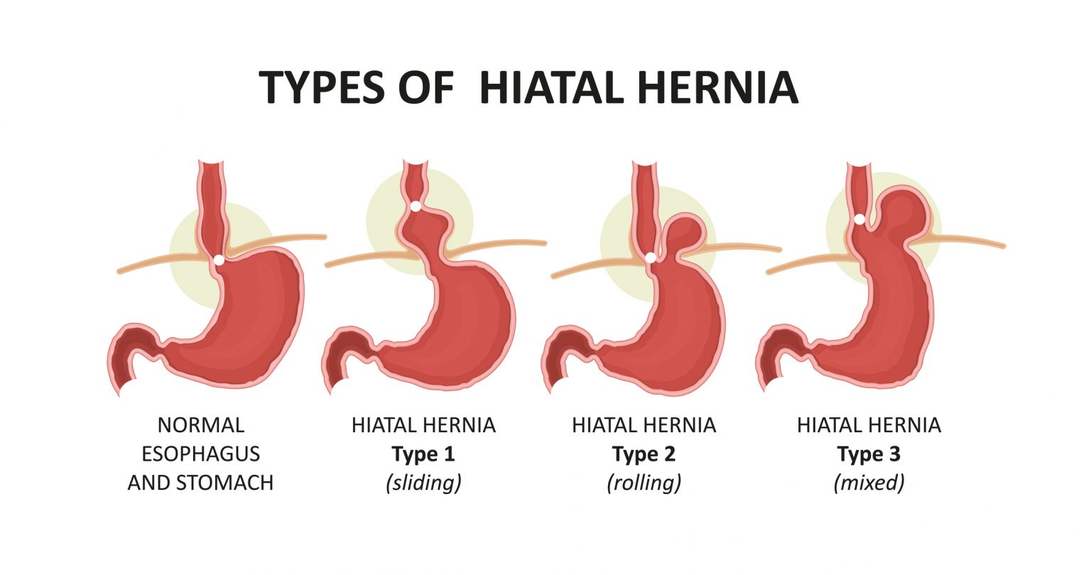 hiatal-hernia-surgery-cost-in-india-mejocare