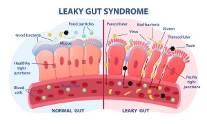 leaky gut syndroom