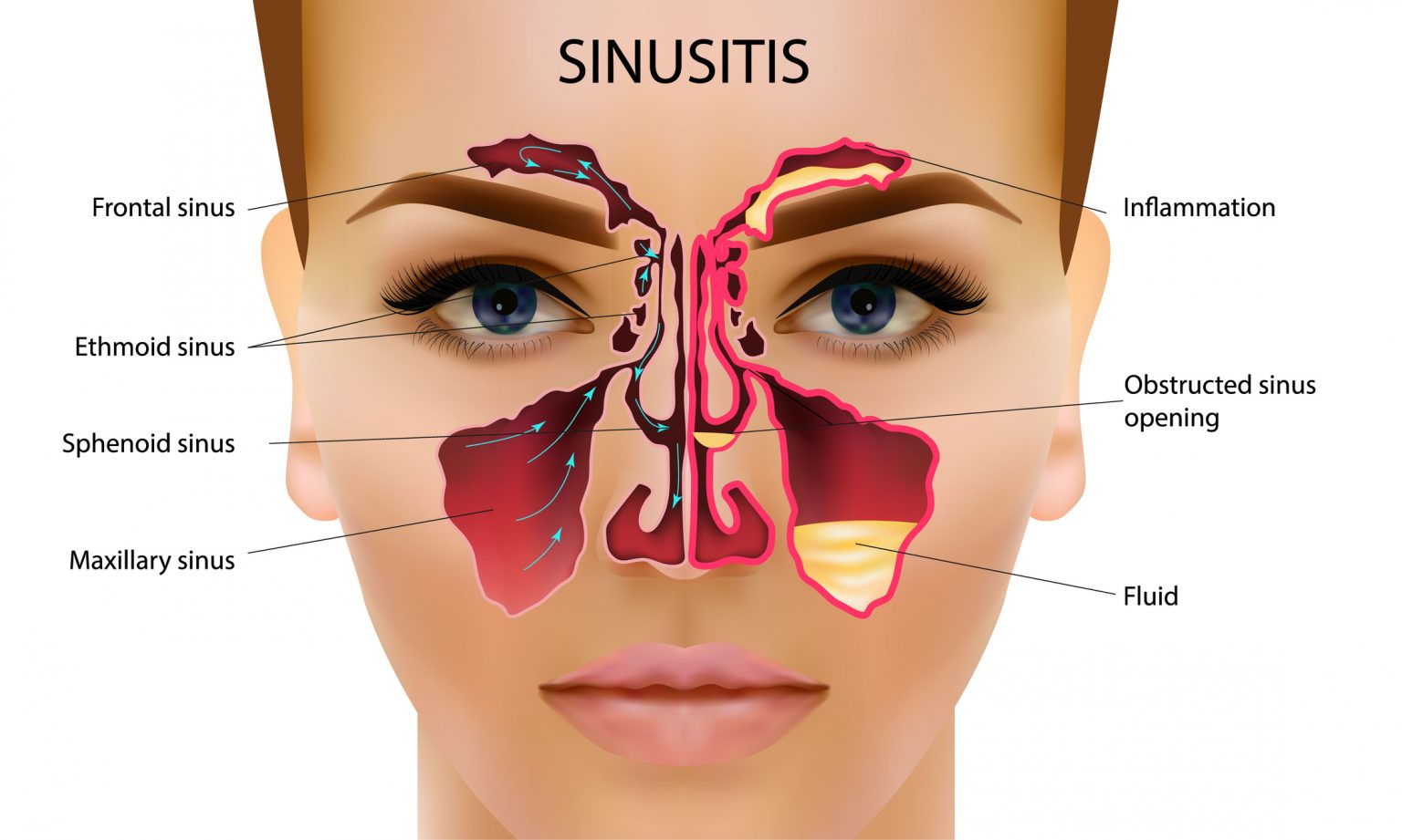 Can Wisdom Teeth Cause Sinus Congestion