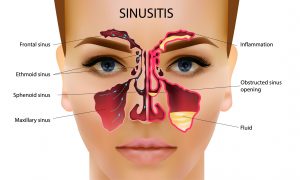 verschillende sinussen betrokken bij sinusitis (bijholteontsteking) 