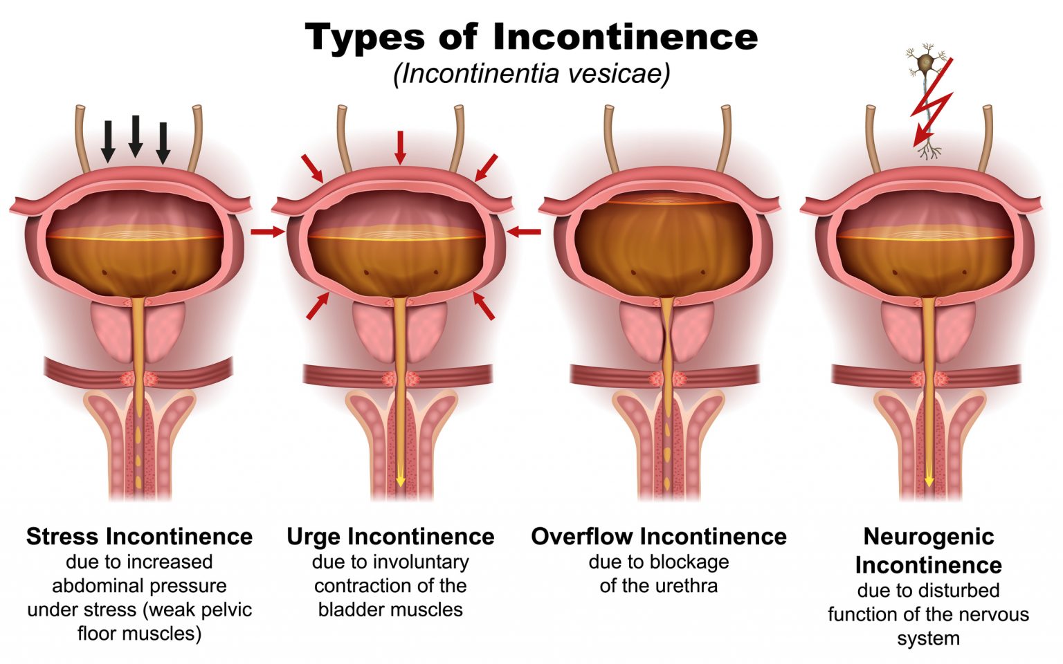 urine-incontinentie-integraal-medisch-centrum